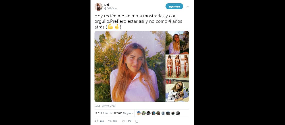 Se hizo viral su lucha contra la anorexia