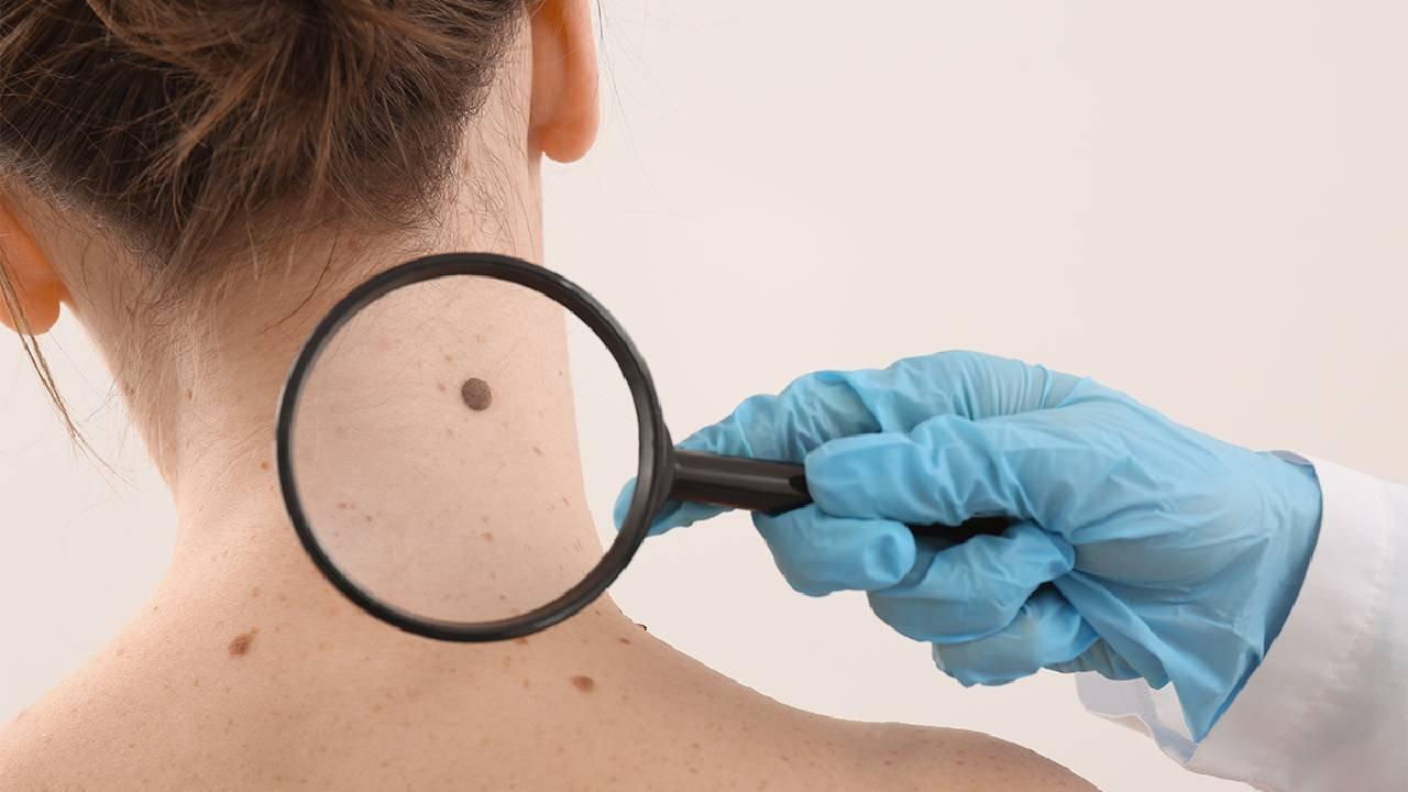 Caacutencer de piel- su diagnoacutestico temprano mejora las posibilidades de tratamiento exitoso