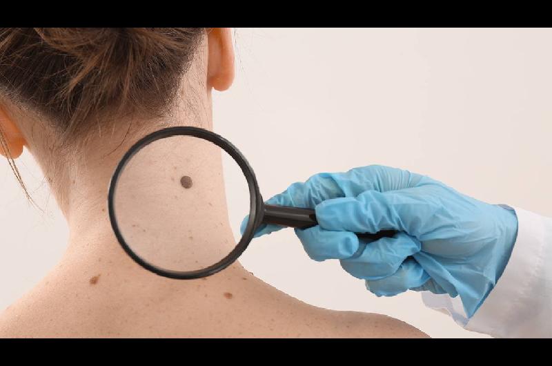 Caacutencer de piel- su diagnoacutestico temprano mejora las posibilidades de tratamiento exitoso