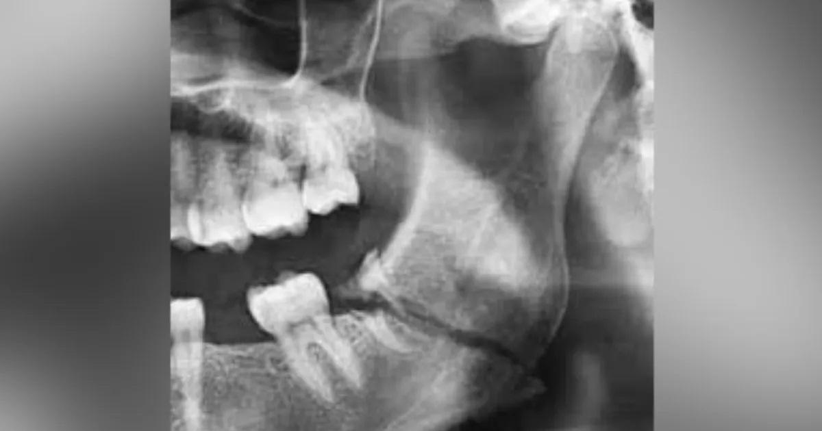 Su ex pareja le fracturoacute la mandiacutebula a puntildeetazos tras una escena de celos