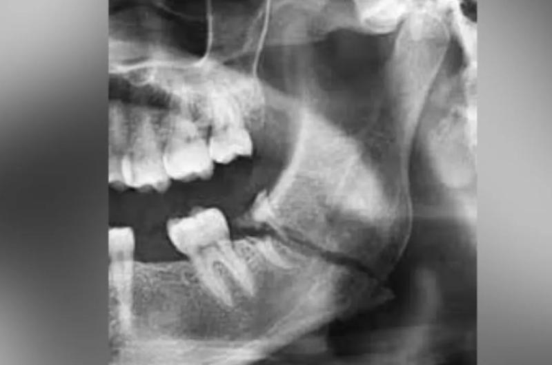 Su ex pareja le fracturoacute la mandiacutebula a puntildeetazos tras una escena de celos