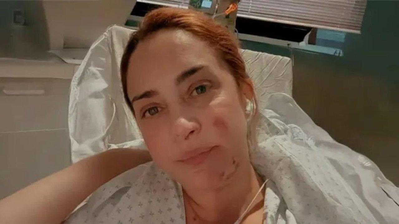 Mariacutea Julia Olivaacuten mostroacute coacutemo quedoacute su brazo tras el terrible accidente con una estufa
