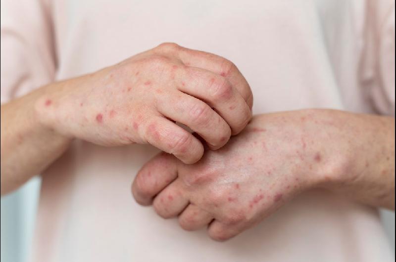 Meacutexico reporta maacutes de 2900 casos sarampioacuten y hay contagios entre migrantes