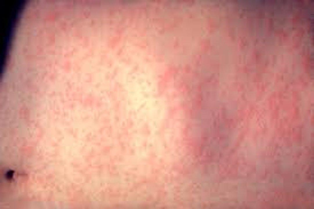 Paraguay confirmoacute un caso de sarampioacuten tras 10 antildeos de eliminacioacuten de circulacioacuten del virus