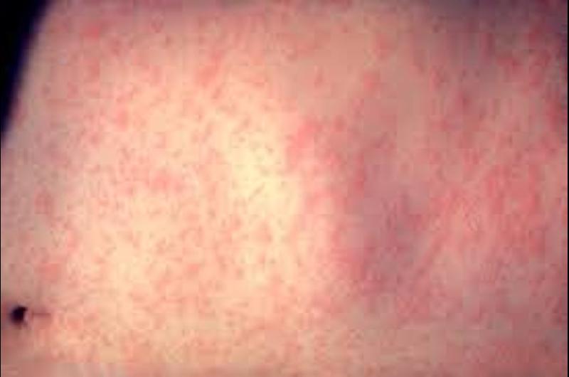 Paraguay confirmoacute un caso de sarampioacuten tras 10 antildeos de eliminacioacuten de circulacioacuten del virus