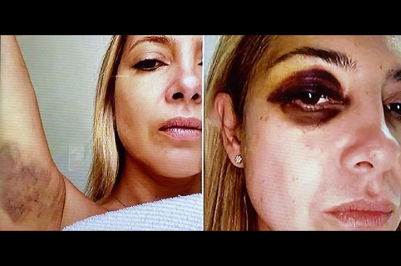 Fabiola Yantildeez ratificoacute que Alberto Fernaacutendez la golpeoacute- ldquoEse ojo morado existioacuterdquo