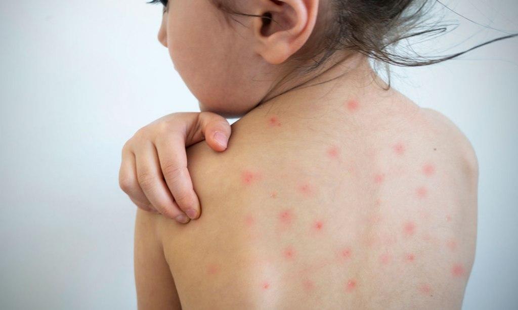 Casos de sarampioacuten en Estados Unidos alcanzan su nivel maacutes alto en 35 antildeos