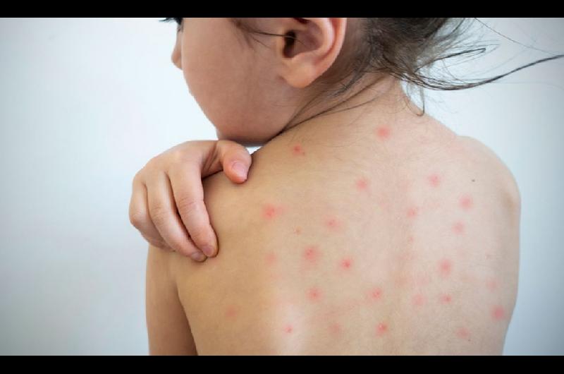 Casos de sarampioacuten en Estados Unidos alcanzan su nivel maacutes alto en 35 antildeos